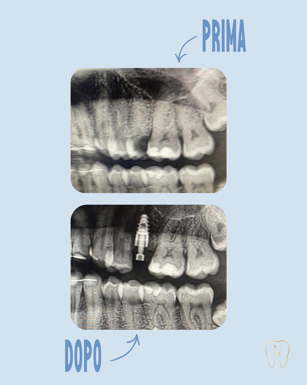 Prima e dopo riabilitazione implantare immediata – estrazione e inserimento impianto in un'unica seduta