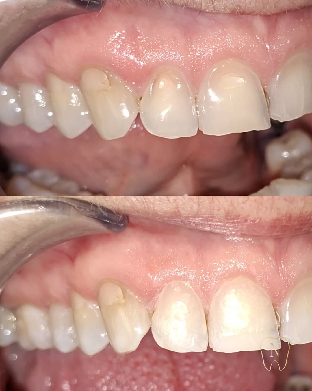 Ricostruzione estetica in composito per difetto dello smalto dentale
