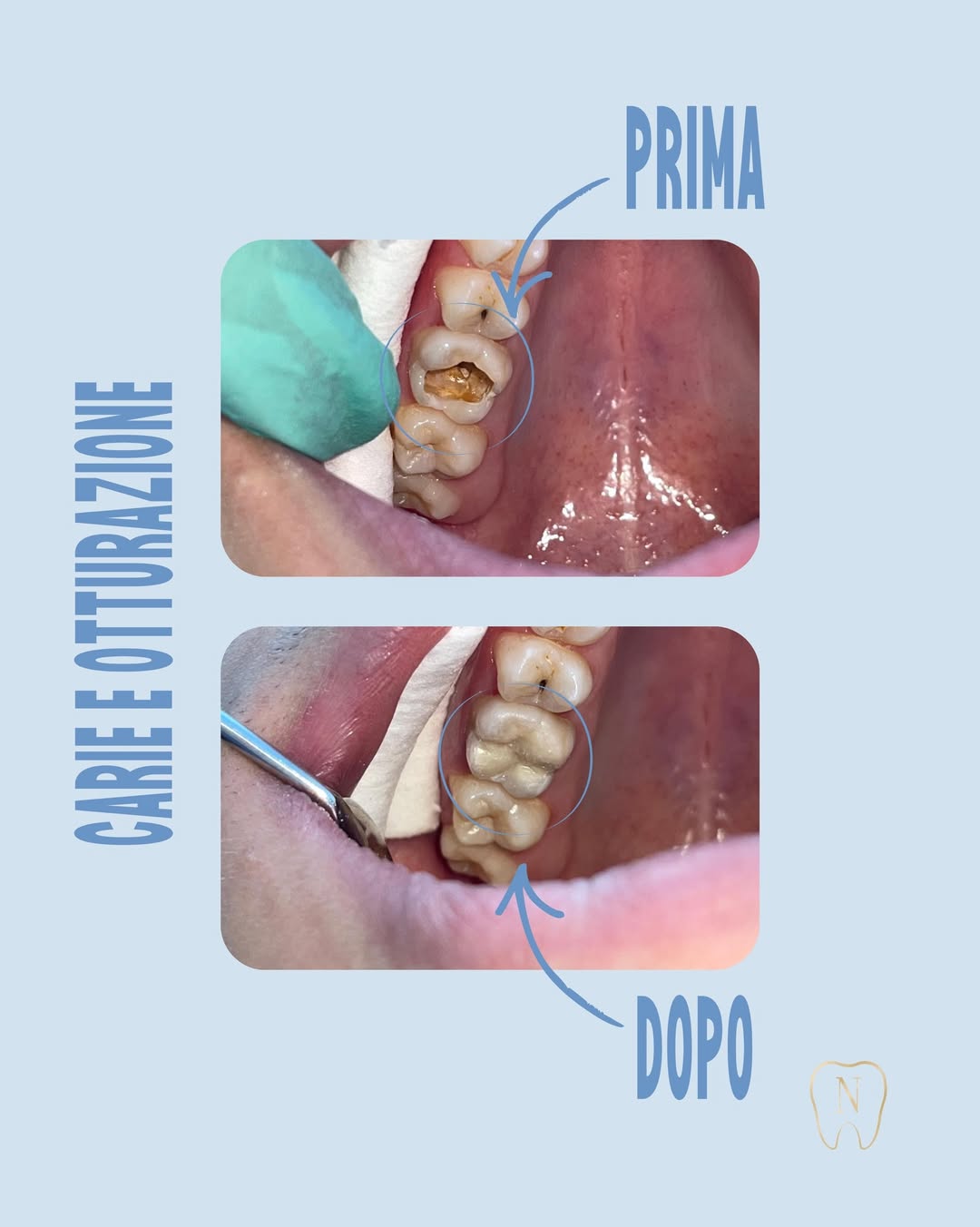 Rimozione carie e ricostruzione estetica in composito