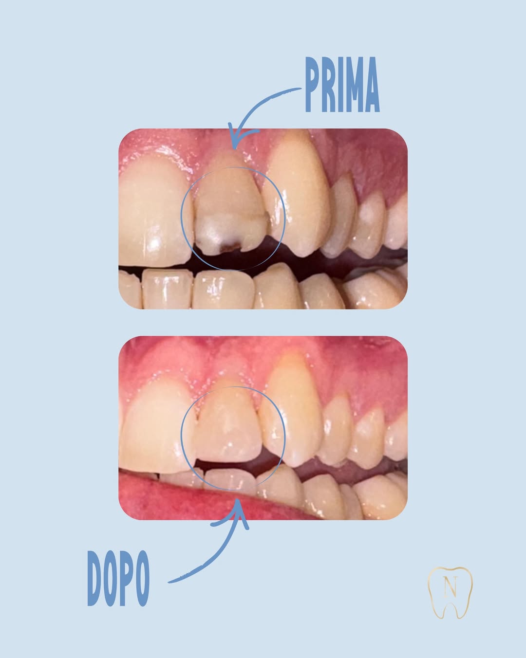 Rimozione carie secondaria da infiltrazione su otturazione in composito pregressa