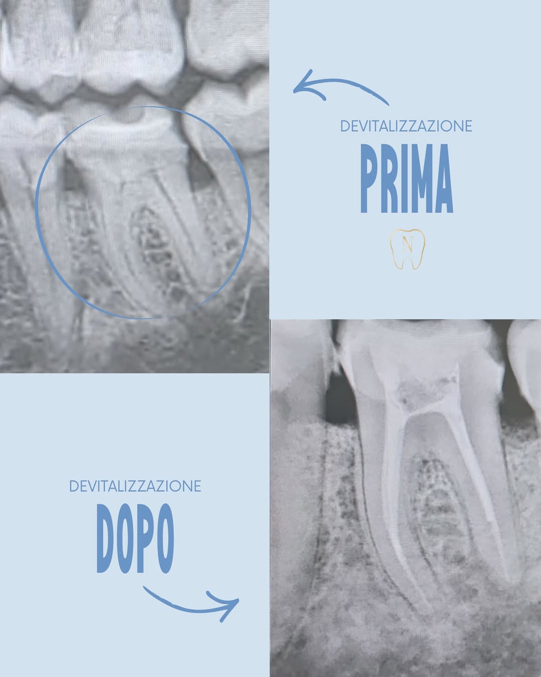 Prima e dopo trattamento endodontico per pulpite causata da lesione cariosa