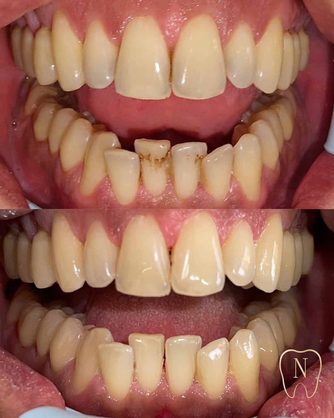 Prima e dopo igiene dentale professionale con rimozione tartaro e pigmentazioni